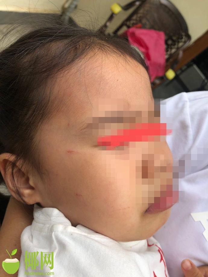 哈罗公学幼儿园3岁女童2天脸上18道伤痕 校方拒绝民警进入校园 - 第4张